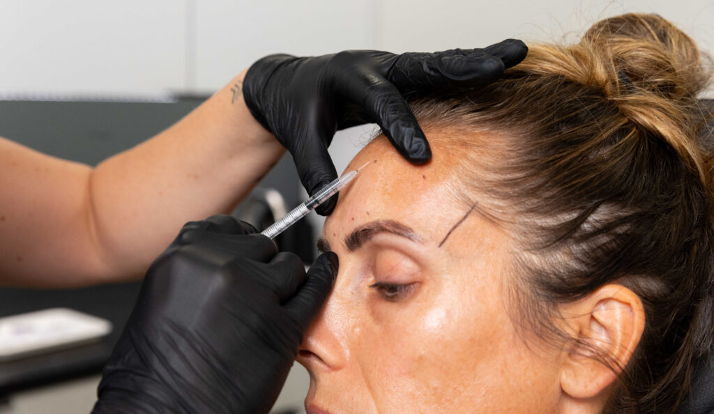 A provider at Icon Aesthetics carefully administers a patient's Botox near Shorewood Forest, IN. Wearing surgical gloves, the provider is injecting the wrinkle relaxers in the forehead to reduce the appearance of deep lines.